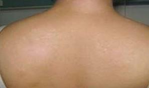 武汉儿童要怎么治疗白癜风