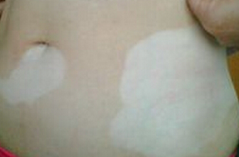 武汉哪些治疗白癜风的医院可靠