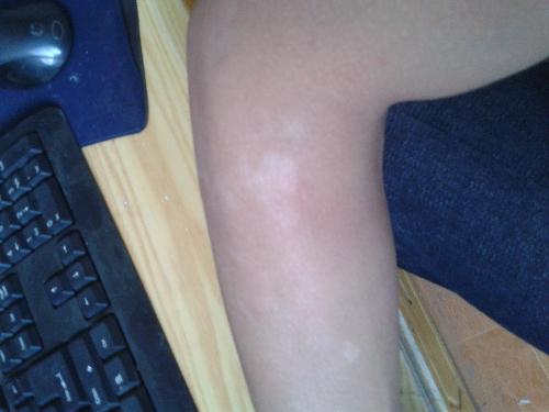 武汉治疗白癜风有哪些好方法