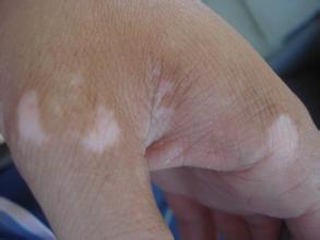 武汉白癜风医院:白癜风怎么治疗?