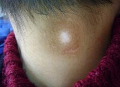 武汉白癫风早期症状