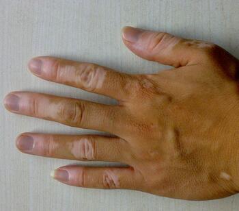 武汉检查白癜风病因用什么方法