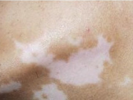 武汉白癜风初期怎么控制和预防