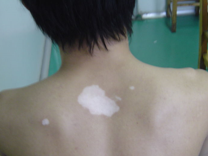 武汉儿童白癜风的初期症状