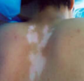 武汉治疗白殿环亚更优秀