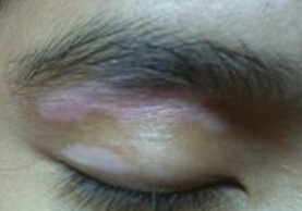 武汉医院治白环亚定行