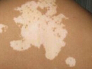 武汉白癫毕环亚